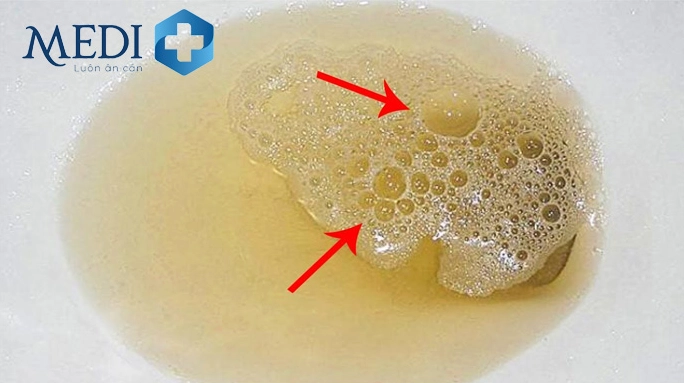 Nước tiểu có bọt: Khi nào là bình thường, khi nào cần lo lắng? Nước tiểu có bọt bất thường