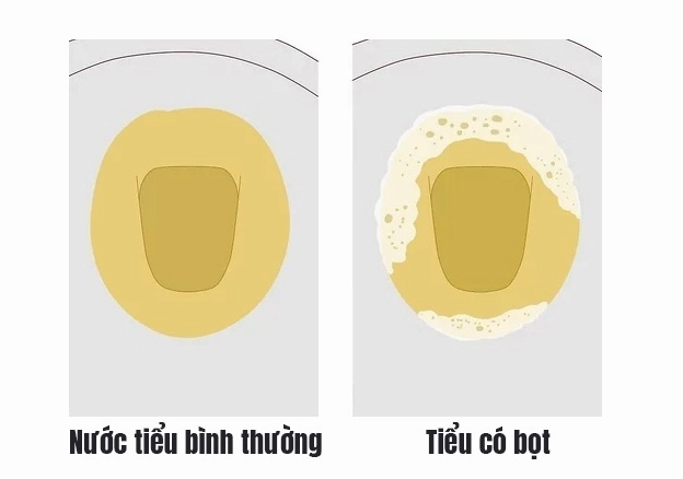 Nước tiểu có bọt: Khi nào là bình thường, khi nào cần lo lắng? Nước tiểu có bọt và bệnh thận