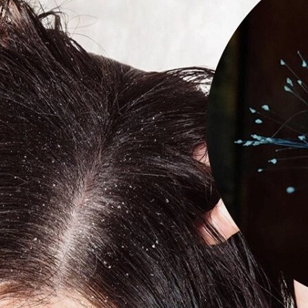 Chân tóc trắng khi rụng là dấu hiệu cần lưu ý