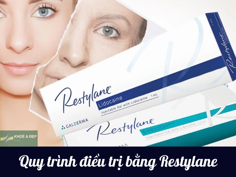 Filler Restylane của nước nào? Giải đáp chi tiết A-Z 2026 Quy trình tiêm filler Restylane